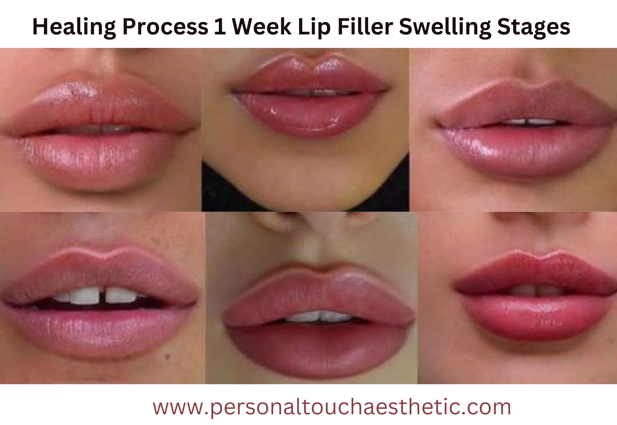 Healing Process 1 Week Lip Filler Swelling Stages