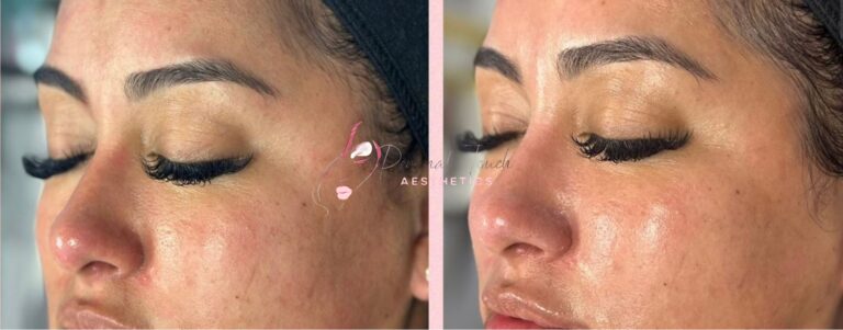 Chemical Peel Process