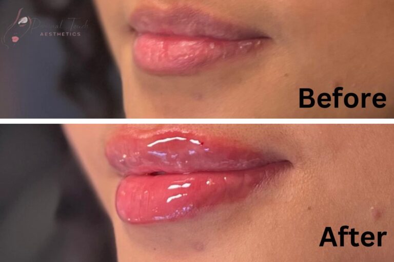 0.5ml lip fillers on thin lips